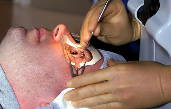 Skleroplastik bei Myopie zur Stabilisierung des Sehvermögens.